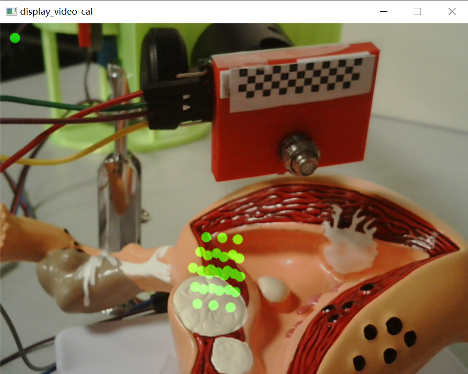 AR assisted Myomectomy Surgery Navigation demo
